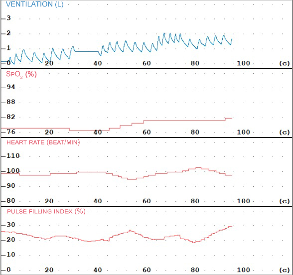 Pulse oximetry